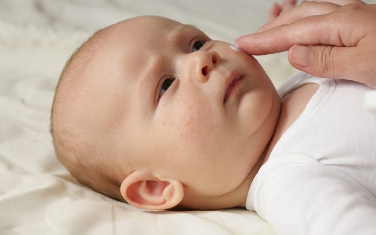 eczema in babies