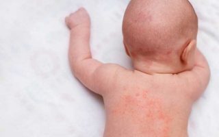 skin rashes in babies