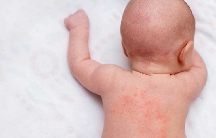 skin rashes in babies