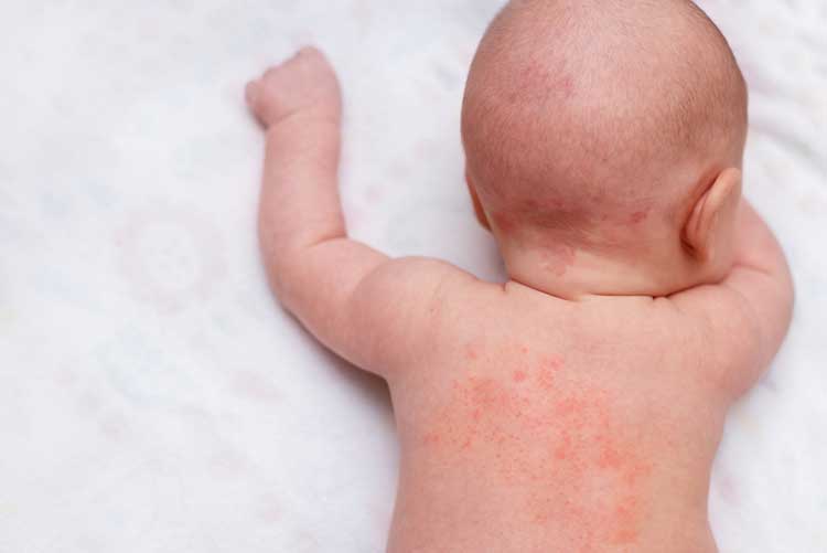 skin rashes in babies